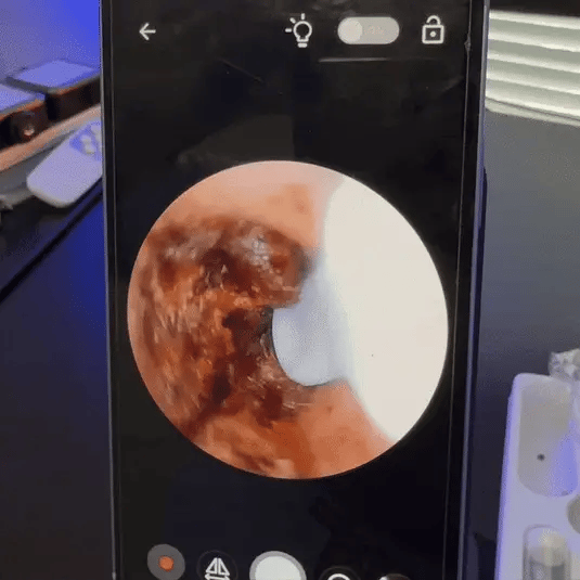 Demostración en vivo de microcámara HD dentro del oído extrayendo cera